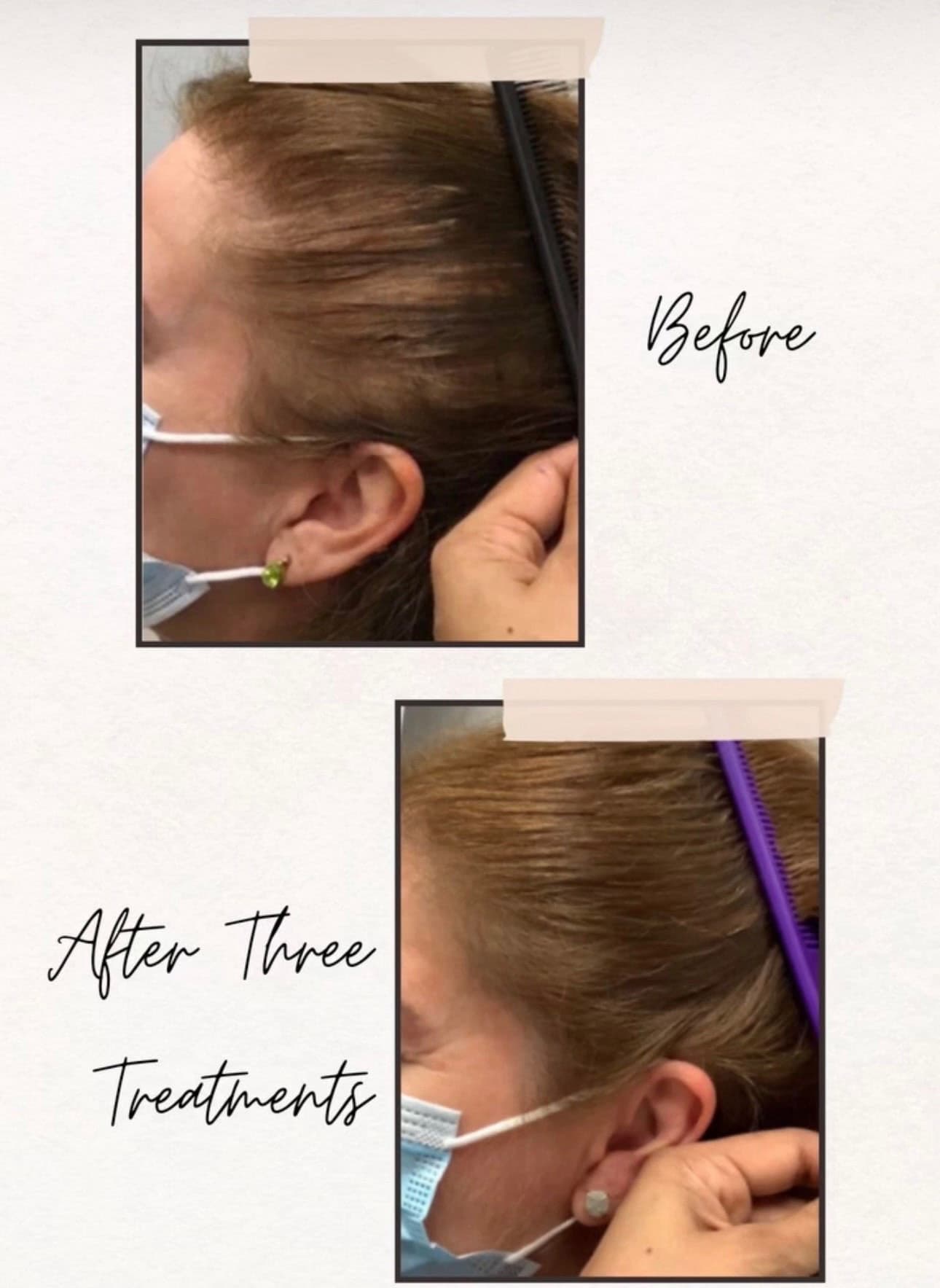 Thinning along the front hairline before treatment, and fuller coverage after three treatments
