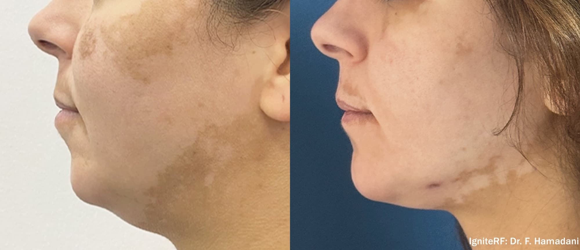 IgniteRF treatment softening facial pigmentation, before and after