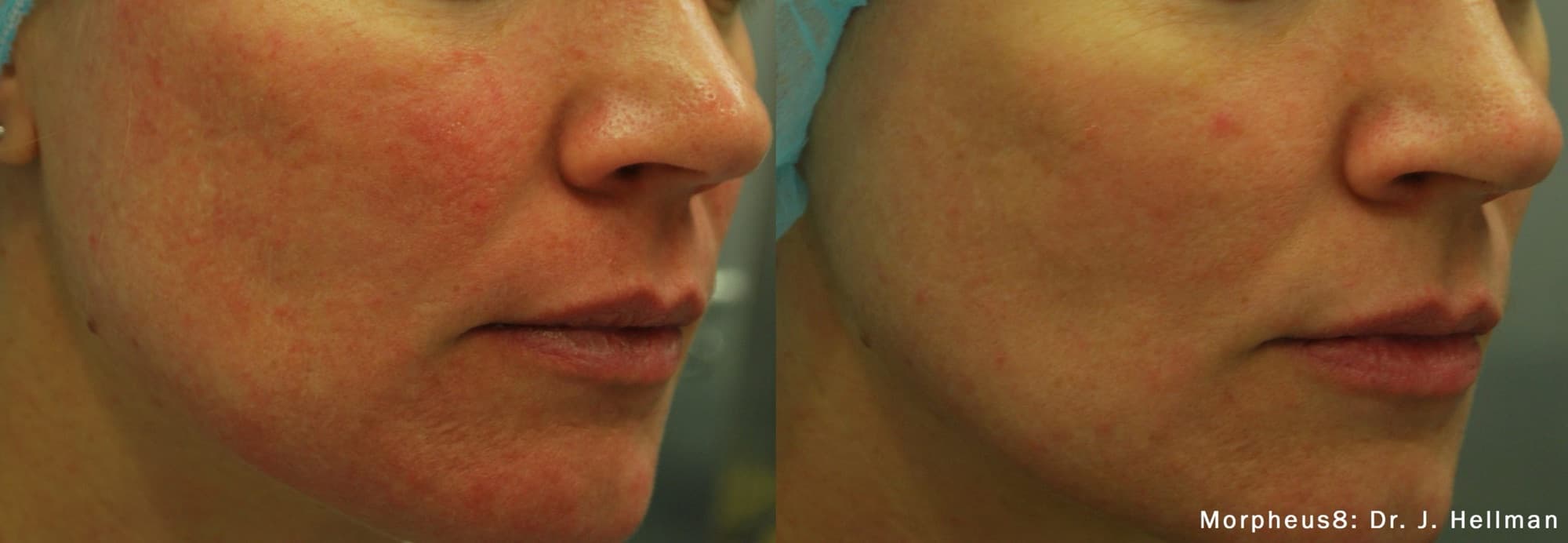 Morpheus8 reducing cheek redness and refining texture, before and after